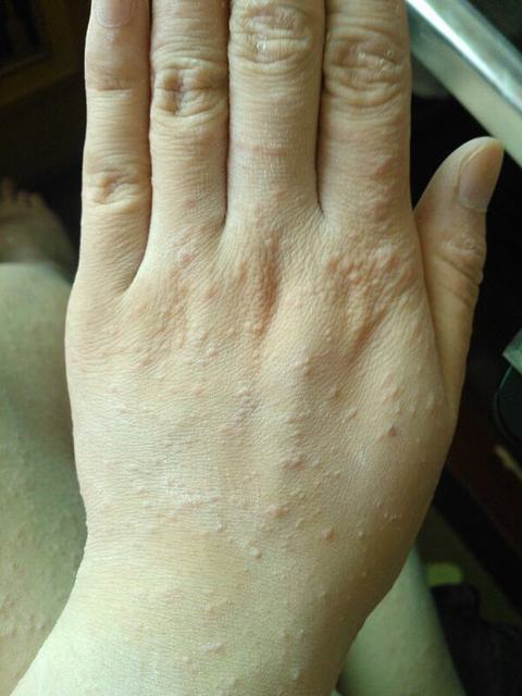 玫瑰糠疹的临床症状是什么