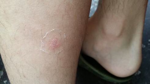 预防牛皮癣要注意哪些生活细节