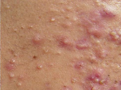秋季皮肤过敏如何预防