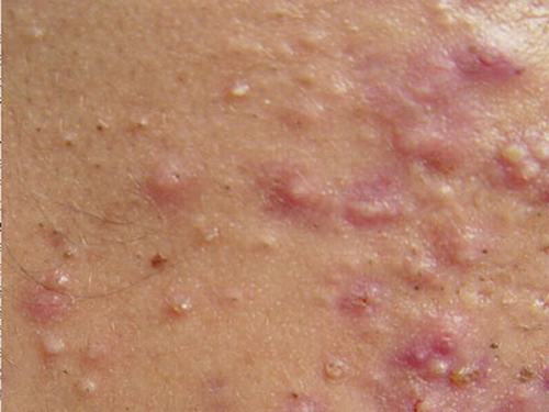 过敏性皮炎怎样护理皮肤