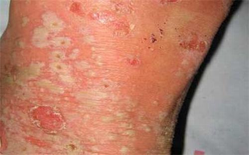 皮肤瘙痒会引起哪些并发症出现