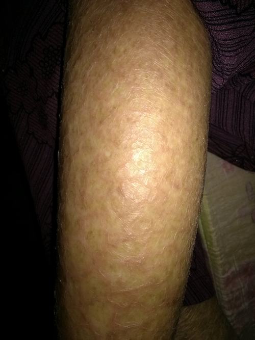 皮肤瘙痒可能导致哪些并发症