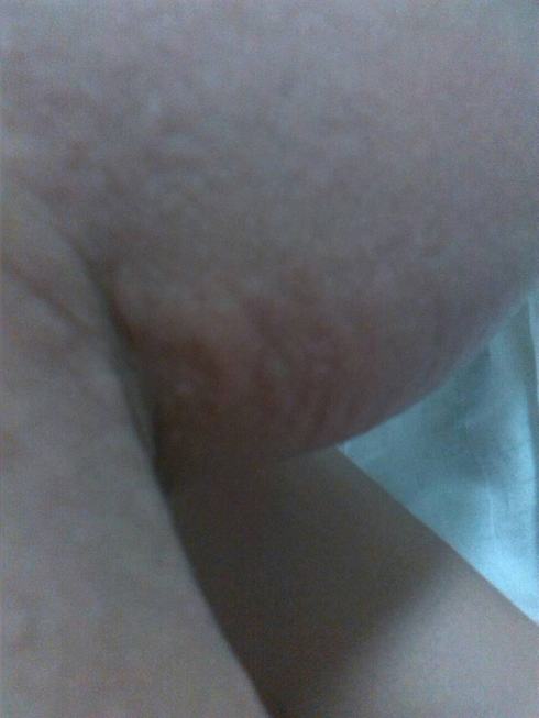 得了皮肤瘙痒有什么症状