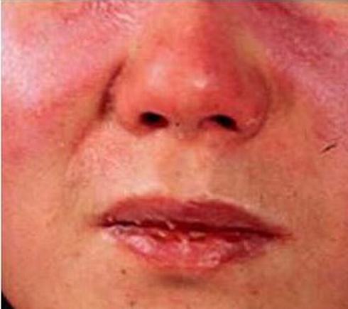 皮肌炎引发多种疾病如何调养预防
