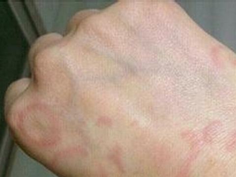 是什么原因导致了皮肌炎的发生