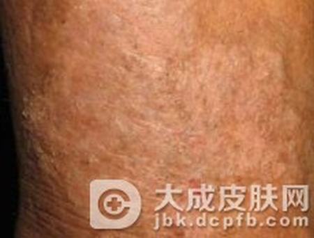 正确的认识瘙痒症的症状