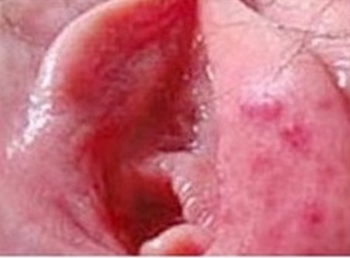 生殖器疱疹复发越来越频繁的原因