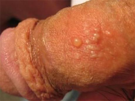 生殖器疱疹存在一定的并发症