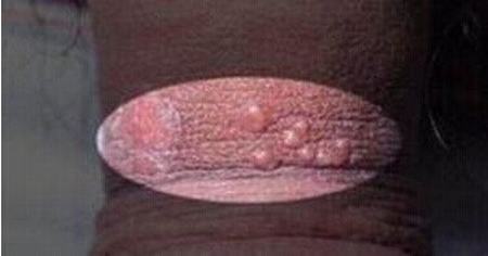 生殖器疱疹不治疗行不行