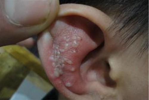 生殖器疱疹总是复发的原因是什么