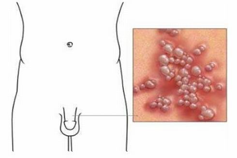 儿童生殖器疱疹有哪些症状