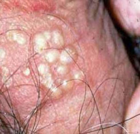 生殖器疱疹患者的常见症状