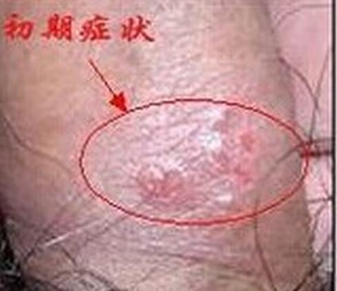 生殖器疱疹的女性症状是什么