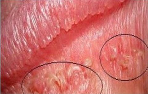 生殖器疱疹饮食注意和护理