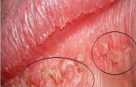 生殖器疱疹患者的饮食结构