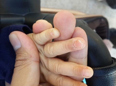 爸妈不要忽视婴儿湿疹
