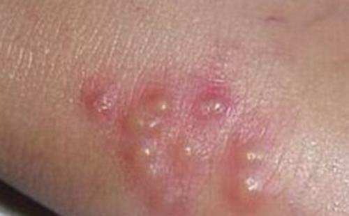 患有水痘在家时该怎样护理？