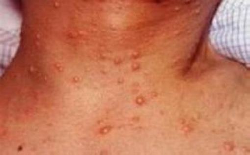 成人患水痘比儿童更严重