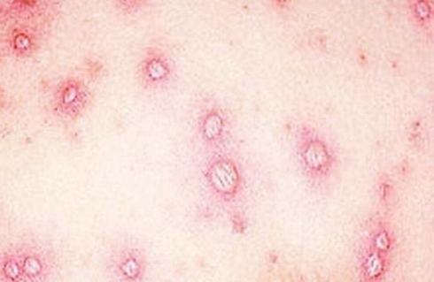 水痘病发时有什么症状