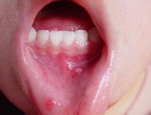 接种水痘减毒活疫苗