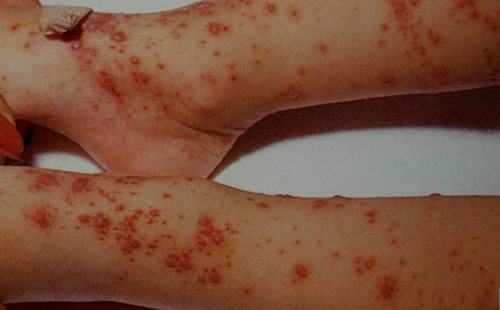 典型水痘有哪些症状
