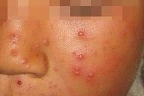 如何区别水痘？