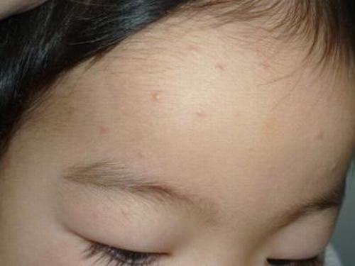 孩子出水痘的症状是什么 