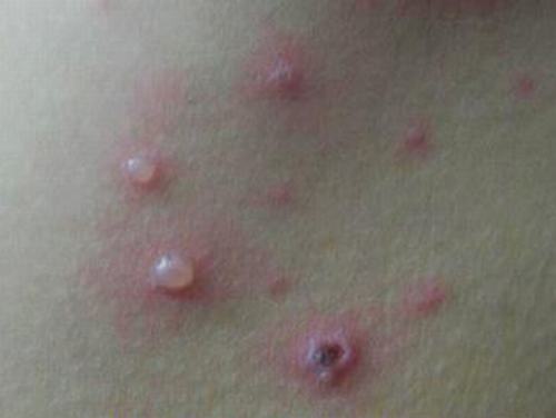 水痘患者有哪些症状 