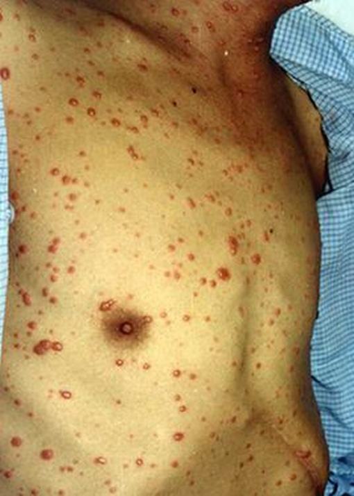 水痘的发病过程是怎样的 