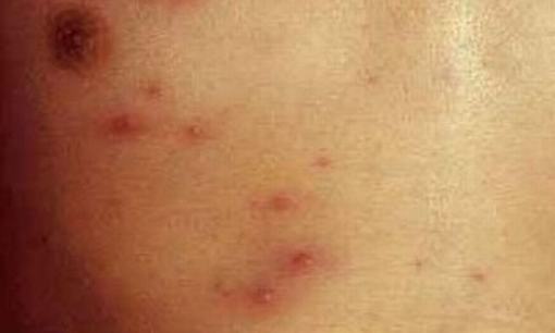 水痘的症状及防护有哪些？