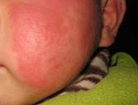 小儿传染性红斑的体征表现