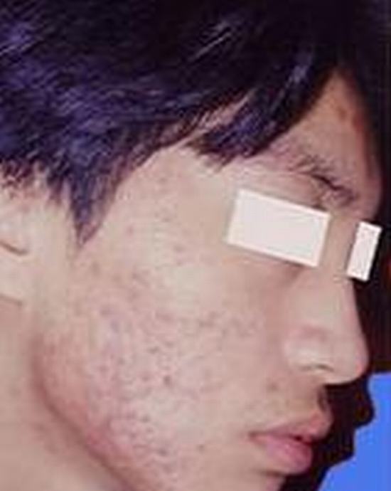 运动对痤疮患者有哪些益处