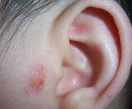 详细的耳湿疹治疗方法
