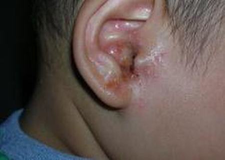 耳湿疹的病因有什么呢