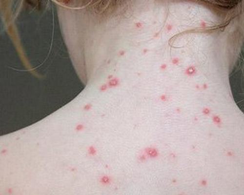 远红光结合中药方法生物共振过敏原检测治疗系统