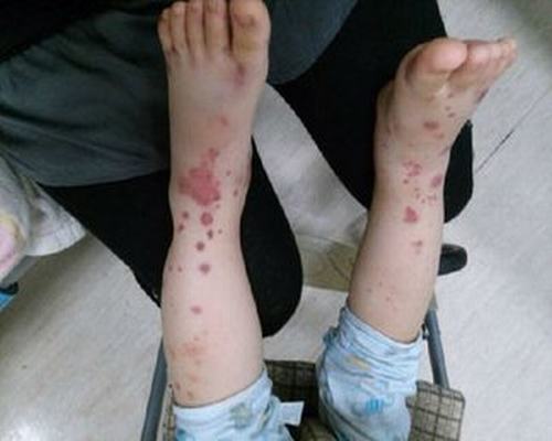 过敏性鼻炎患者一定要戒掉吸烟