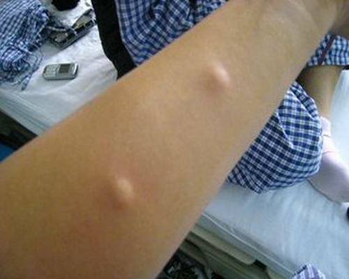 过敏原检测方法
