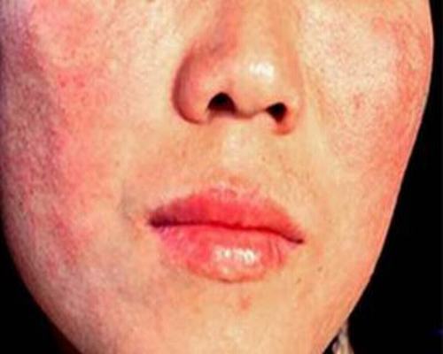 医院过敏源检测费用是多少