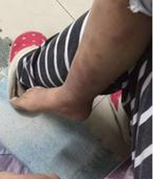 过敏性紫癜性肾炎的伤害有什么