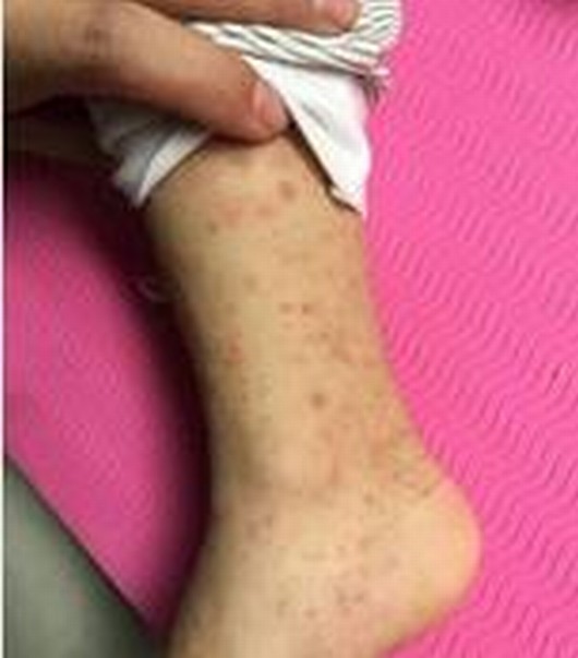 过敏性紫癜症状体现有什么