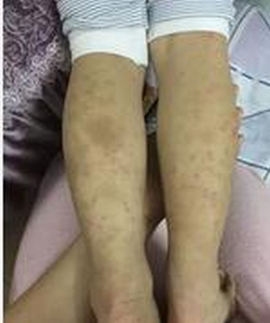 过敏性紫癜症状有哪些