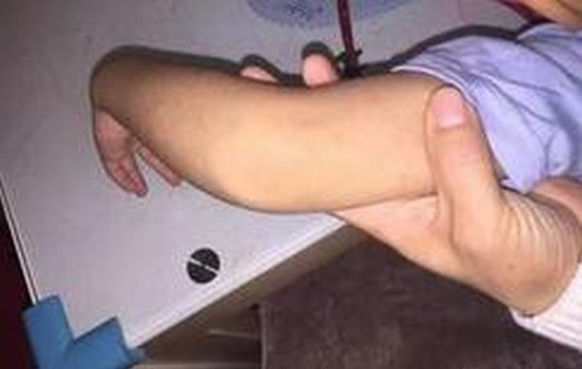 解读过敏性紫癜的病因有什么