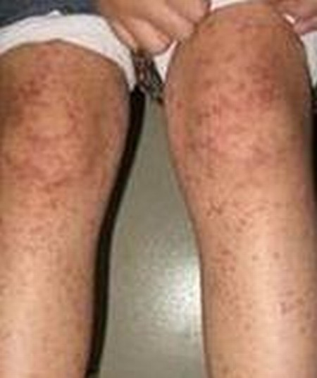 分析的过敏性紫癜的临床症状表现