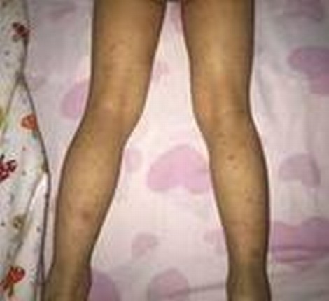 过敏性紫癜的发病方式是怎样的呢