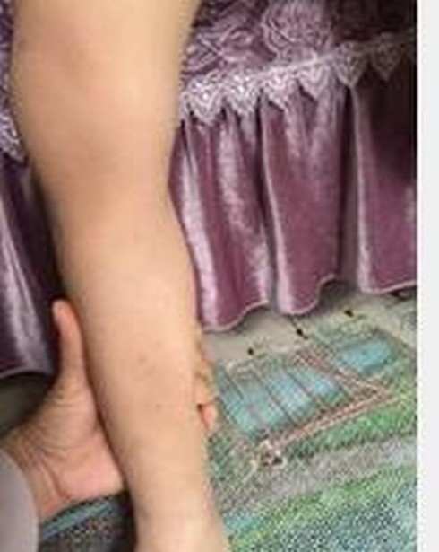 过敏性紫癜复发吗