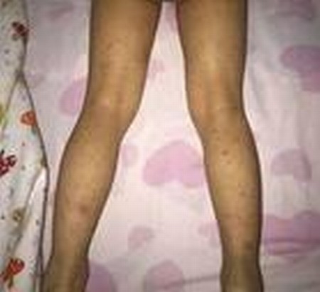 得了过敏性紫癜该吃什么不该吃什么