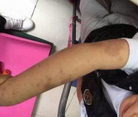 得了过敏性紫癜要求注意哪些