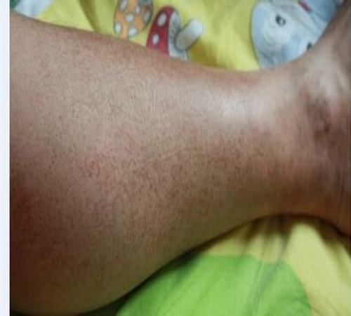 儿童过敏性紫癜症状因人而异