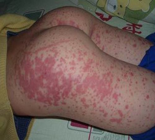 过敏性紫癜还应该做什么检查