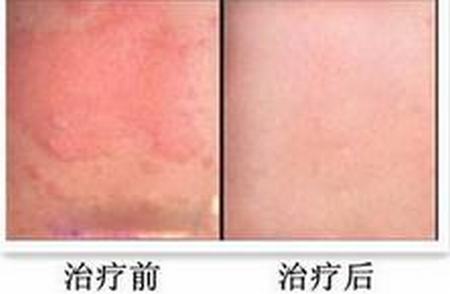 寒冷性荨麻疹会带来什么危害呢